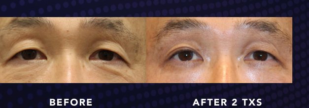 Under-Eye Texture — Alma OPUS Plasma clinical before and after