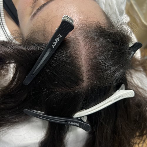 After Alma TED Hair Restoration Mar Essence Med Spa Hicksville NY