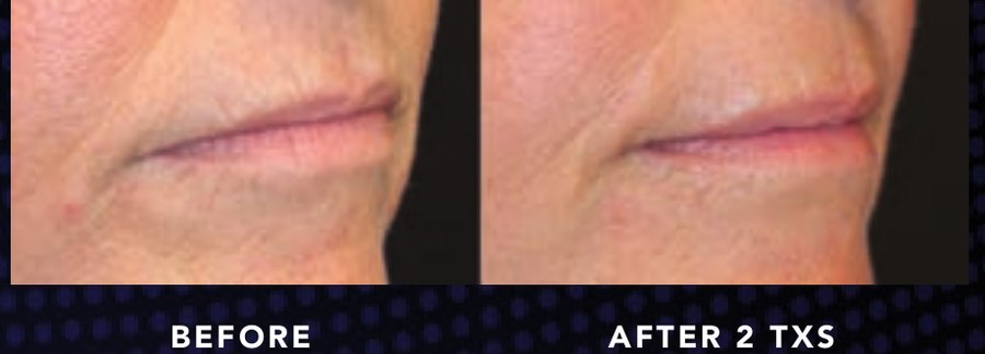 Nasolabial & Perioral Lines — Alma OPUS Plasma clinical before and after
