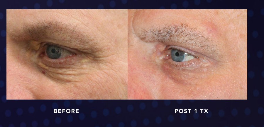 Upper Lid Hooding — Alma OPUS Plasma clinical before and after