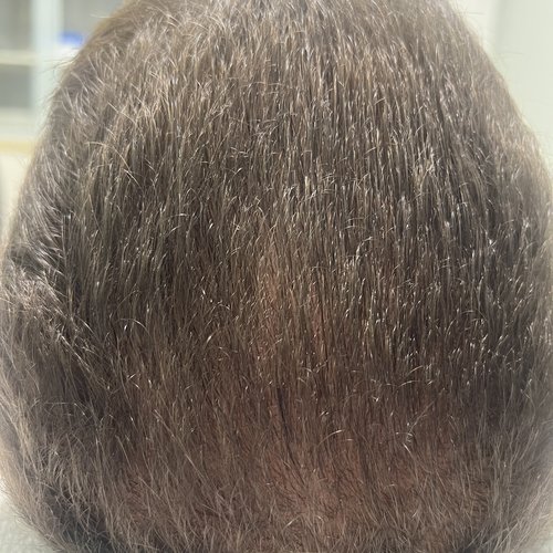 After Alma TED Hair Restoration Mar Essence Med Spa Hicksville NY