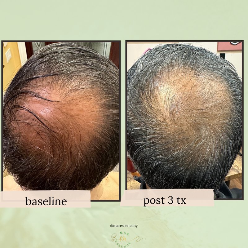 Alma TED Hair Restoration Mar Essence Med Spa Hicksville NY