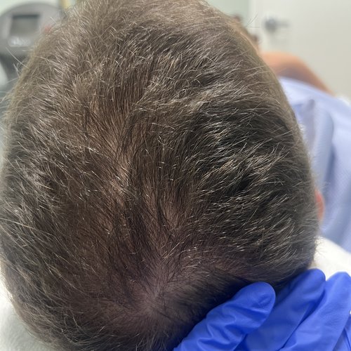 Before Alma TED Hair Restoration Mar Essence Med Spa Hicksville NY
