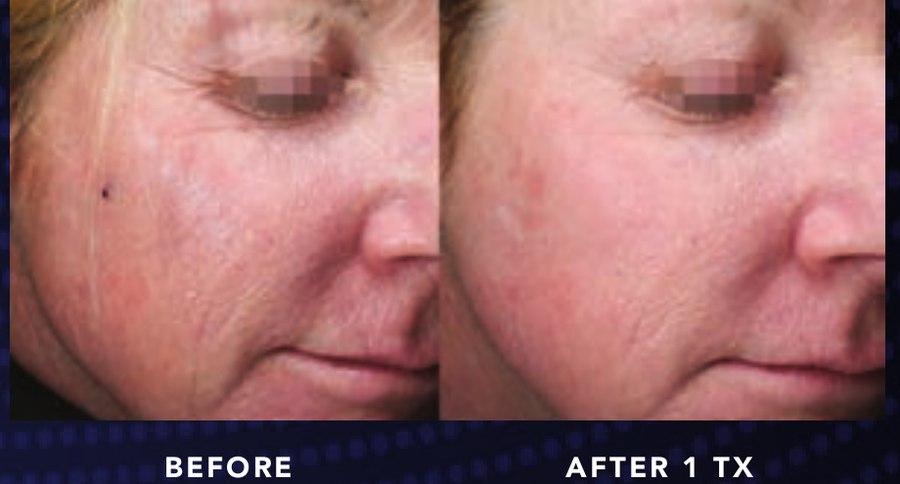 Overall Texture & Fine Lines — Alma OPUS Plasma clinical before and after