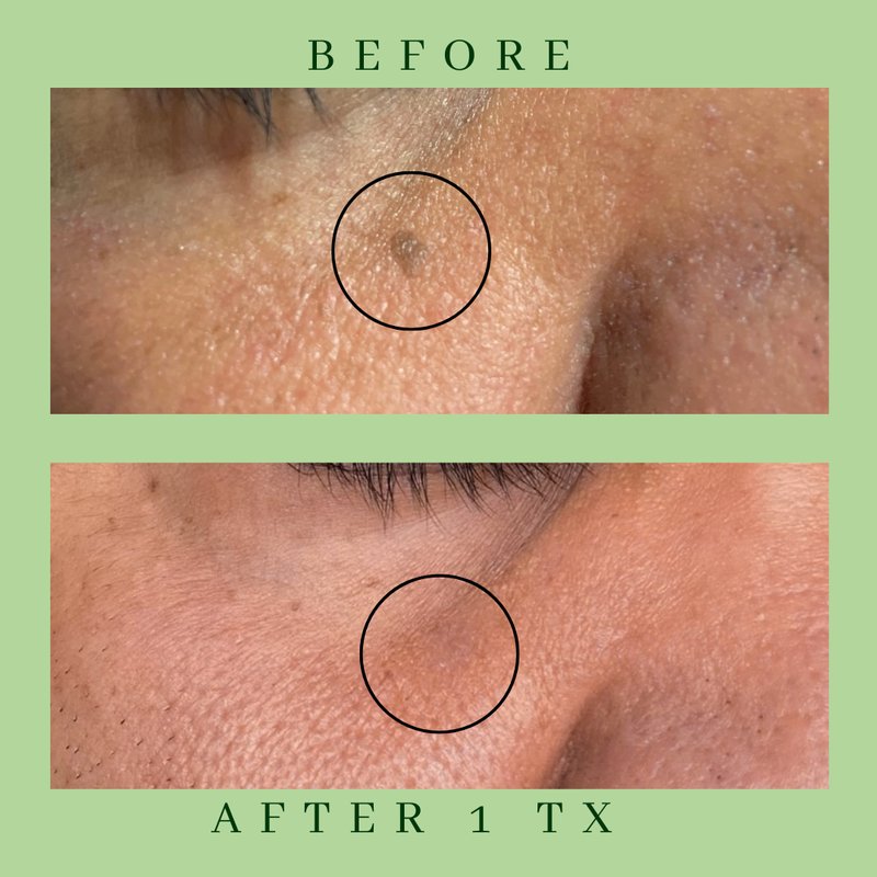 Skin Tag Removal — actual Mar Essence client, after one treatment