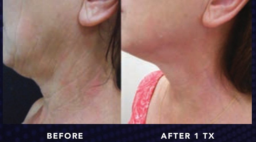 Neck — Alma OPUS Plasma clinical before and after