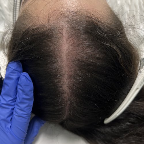 Before Alma TED Hair Restoration Mar Essence Med Spa Hicksville NY