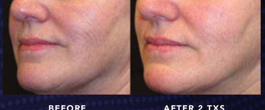 Jawline & Lower Face — Alma OPUS Plasma clinical before and after