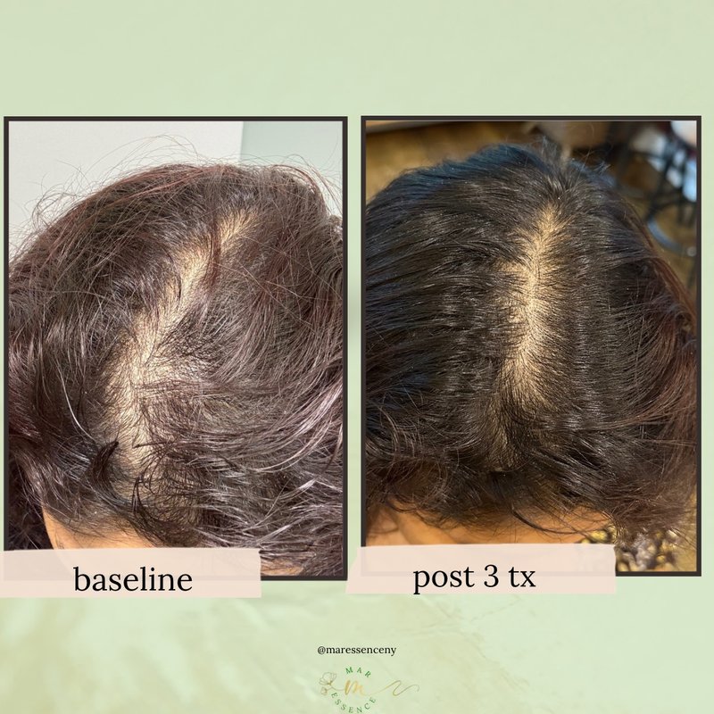 Alma TED Hair Restoration Mar Essence Med Spa Hicksville NY