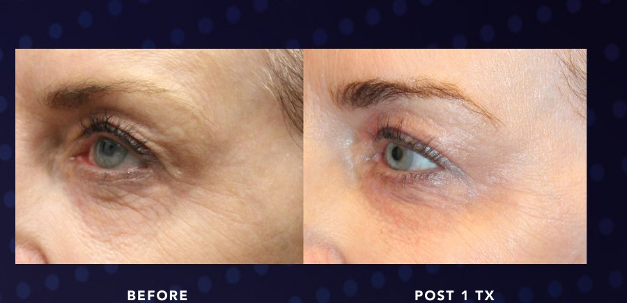 Under-Eye & Lid — Alma OPUS Plasma clinical before and after
